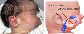 Image result for Micrognathia