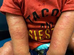 Image result for Atopic Patient