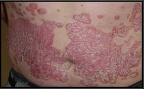 Image result for Lichen Simplex Chronicus