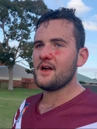 Colonel Light Gardens player Bryce Smith wins match with his face