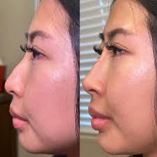 Model Call! I need a model for Botox injections, this Friday ONLY must be  okay with before and after pictures for social media purposes! Interested?  Leave a message and will contact you!