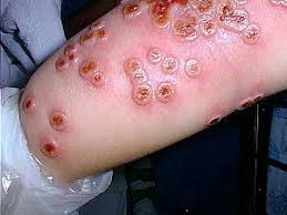 The virus enters the body through broken skin (even if not visible), respiratory tract, or the mucous membranes (eyes. Cowpox Wikipedia