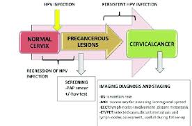 Signs and symptoms of local cervical cancer recurrence may include: Cervical Cancer Disease Progression And Diagnostic Workup Us Download Scientific Diagram