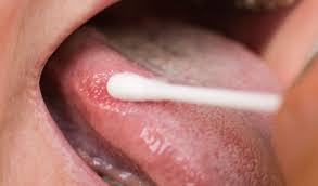 Image result for lichen planus on tongue)