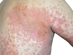 Image result for skin rash acute hiv infection