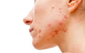 There is much debate about the level of toxicity of ppd. Allergien Beispiel Ppd Haut De