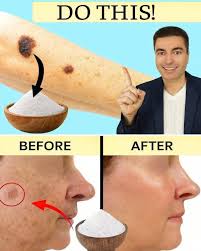 One morning, you look in the mirror and notice those little brown marks  that seem to be settling