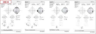 Image result for Visual Field Deficit