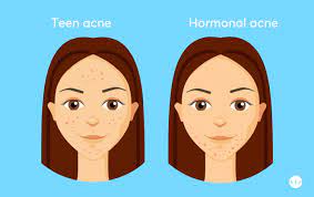 Many studies have looked at how well oral contraceptive pills fight acne. Hormonal Acne Best Treatment According To Dermatologists Mdacne