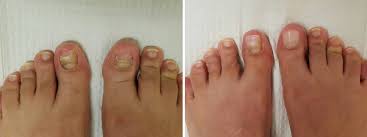 Image result for Koilonychia feet