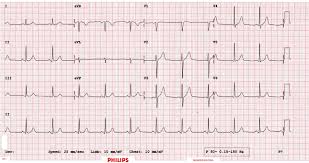 Math Of Ecgs Fourier Series