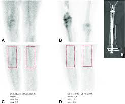 Image result for Osteomyelitis Bone Scan