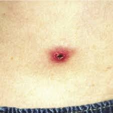 Image result for infected tick bite
