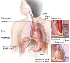 In case of significant obstruction of the esophageal lumen by esophageal web and persistent. Plummer Vinson Syndrome Causes Symptoms Diagnosis Treatment Prognosis