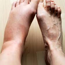 These are both very important questions and could mean the difference between a foot pain that takes days to recover versus months. 10 Causes For Swollen Feet Why Your Feet Ankles Legs Swell