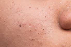 acne types in pictures explanations and treatments