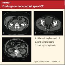 Image result for Nephrolithiasis Imaging