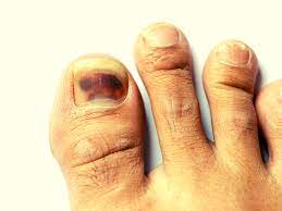 Acral lentiginous melanoma (alm) is a form of skin cancer that appears on the palms of the hands, the soles of the feet, or under the nails. If You Have This Mark On Your Nail Get Tested For Skin Cancer Times Of India