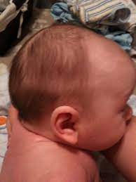 The growth of human hair occurs everywhere on the body except for the soles of the feet, the inside of the mouth, the lips, the backs of the ears, the palms of the hands, some external genital areas. My Baby Is Losing His Hair In A Funny Pattern First Time Mom And Dad