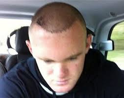 The norwood system of classification, published in 1975 by dr. Young Men With Frontal Hair Loss Seek Surgical Hair Restoration