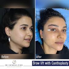 Browlift – Dr. Georges Ziade Clinics