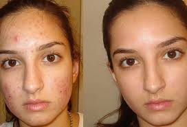 Sivilce Ve Sivilce Izlerini Yok Eden Karbonat Maskesi Evde Nasil Yapilir Akne Tedavisi Sivilce Izi Skin Care