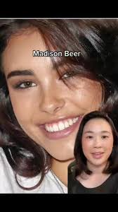 Madison Beer Smile Transformation: Before vs After Veneers