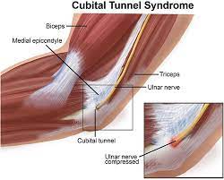 Physical Therapy Guide To Cubital Tunnel Syndrome Choosept Com