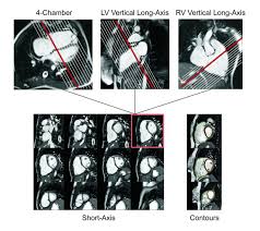 Muster 32 lochmuster unterbrochenes zick zack stricken. Repaired Tetralogy Of Fallot The Roles Of Cardiovascular Magnetic Resonance In Evaluating Pathophysiology And For Pulmonary Valve Replacement Decision Support Journal Of Cardiovascular Magnetic Resonance Full Text