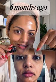 Glow Queen Erfahrung Lichtbehandlung