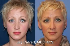 Spreader graft information including symptoms, causes, diseases, symptoms, treatments, and other these medical condition or symptom topics may be relevant to medical information for spreader graft Rhinoplasty Technique Spreader Grafts Dr Jay Calvert