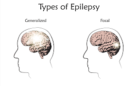 The epilepsy foundation is your unwavering ally on your journey with epilepsy and seizures. What Are The Different Types Of Seizures Epilepsy Queensland