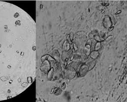 uric acid crystals under a microscopeの画像