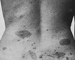 Neurofibromatosis - Types And Treatments - Orthoinfo - Aaos