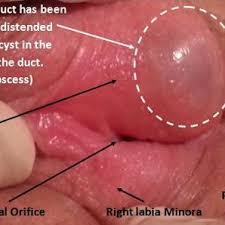 Image result for Bartholin's gland abscess