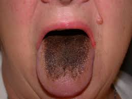 Image result for black hairy tongue symptoms