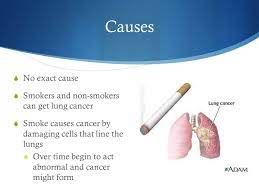 Due to their location away from the large airways, these tumors often grow quite large or spread before they cause any symptoms. Lung Cancer Sydney Freedman And Rachel Rea Causes No Exact Cause Smokers And Non Smokers Can Get Lung Cancer Smoke Causes Cancer By Damaging Ppt Download