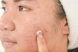 Wash your face or body where scars are there & apply the mint glue on the scars. How To Get Rid Of Acne Scars Using Baking Soda How To Treat Your Skin With The Household Ingredient