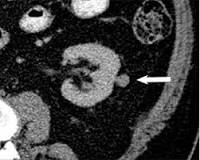 Image result for icd 10 code for cyst of kidney
