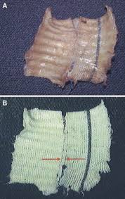 Loops of yarn in a row, either flat or in the round (tubular). Longitudinal Ruptures Of Polyester Knitted Vascular Prostheses Journal Of Vascular Surgery