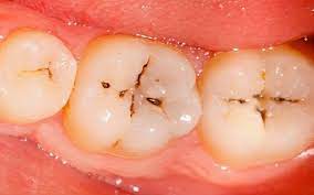 If a baby tooth is lost before the permanent teeth beneath it is ready to emerge, it will allow the adjacent teeth to shift and occupy the. These 7 Home Remedies Will Solve Your Tooth Decaying And Cavities