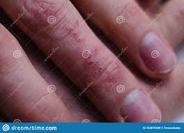 Imagina que estás en un campo de batalla y que los la aparición de ronchas rojizas en la piel al exponerse al sol. Psoriasis La Psoriasis Es Una Enfermedad Autoinmune Que Afecta A La Piel Causa Inflamacion De La Piel Enrojecimiento Y Escalofrio Imagen De Archivo Imagen De Enfermedad Autoinmune 163875309