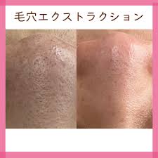 teteエクストラクションで別人鼻 | 横浜青葉台シミ毛穴たるみ改善専門のエステ美キュート