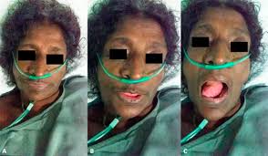 Td movements occur in one or more spots of the body and are often seen. Amitriptyline Induced Tardive Dyskinesia In A Patient With Cirrhotic Parkinsonism Sciencedirect