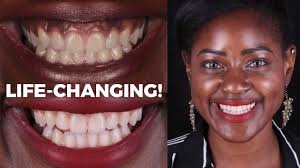Periodontal disease, also know as gum disease, is the major cause of tooth loss in adults. How I Turned My Black Gums To Pink Life Changing Gum Depigmentation Experience Youtube