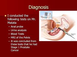 The samples of tissue from the biopsy are studied in a laboratory. Prostate Cancer Ppt Download