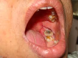 Most melanomas are either brown or black. Oral Cancer How Worried Are You Please Note This Thread Contains Pictures Page 5 Team Bhp