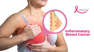 Image result for Inflammatory breast cancer
