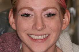 Advantages of ArchONE's Full Arch Implant System