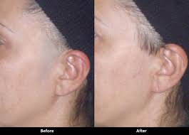 Waxing sideburn and face by daniel and patricia. Dr Alex S Blog Laser Hair Removal